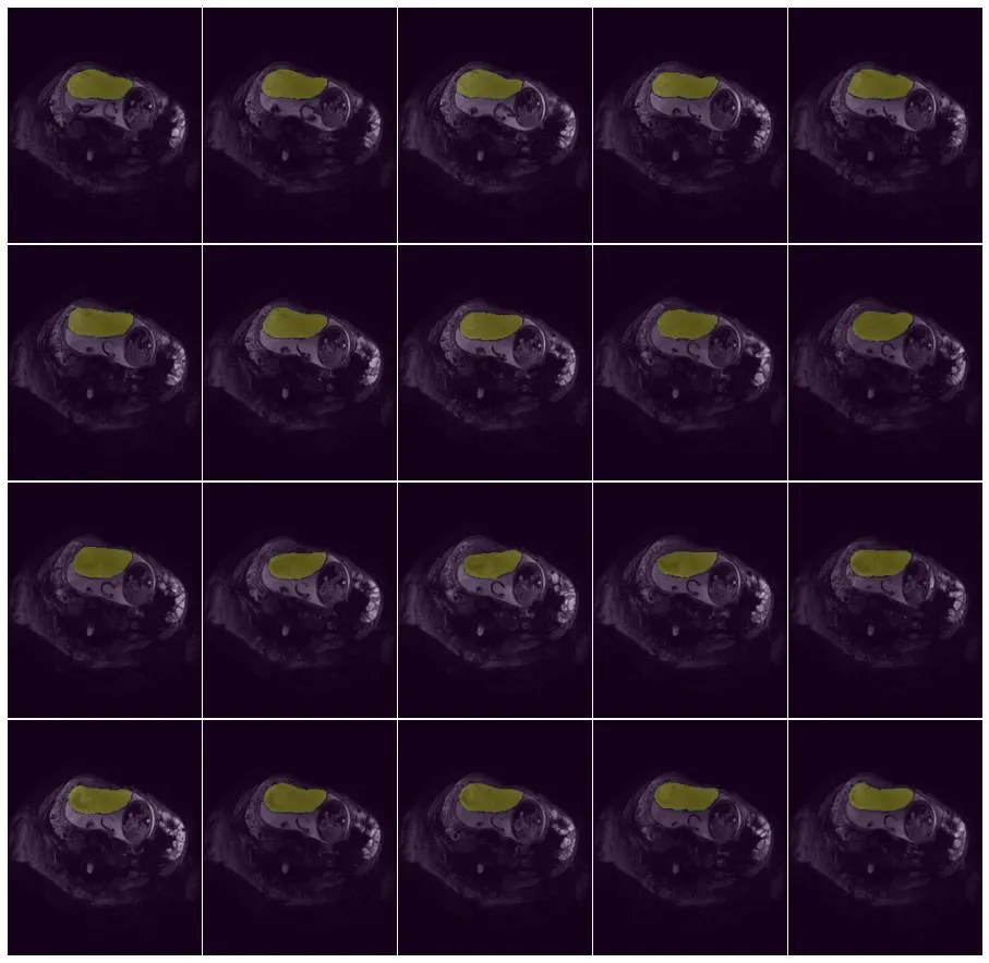 Placenta Dataset Sample